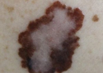 What Are the Best Options for Basal Cell Carcinoma Treatment in Orange, CA?